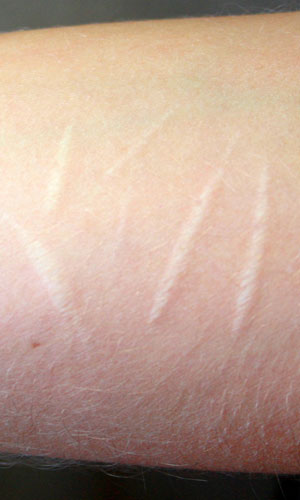 self-harm-scar